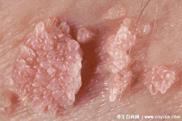 真假疣的辨别，痒感是否可靠？