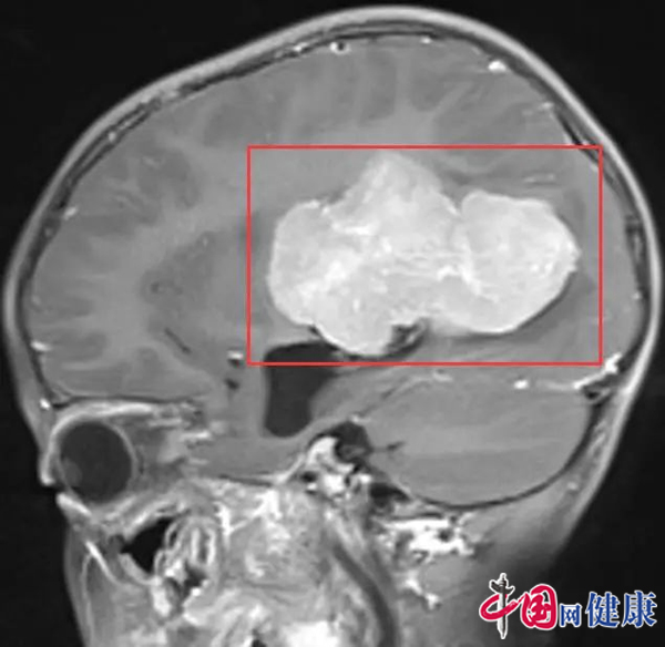 游戏主播唐6儿脑部长肿瘤确诊